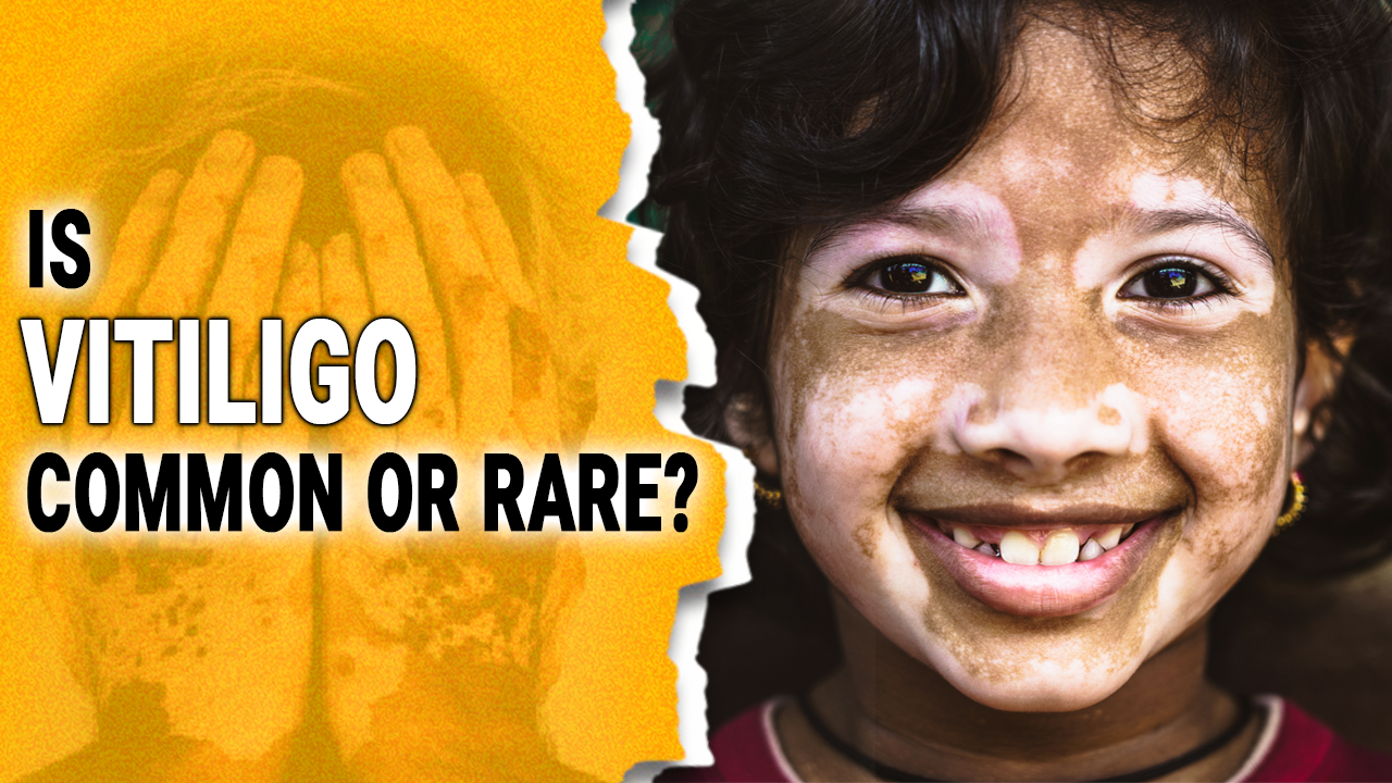 Vitiligo - A Skin Disease | All About Vitiligo/Leucoderma